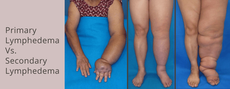 The Difference Between Primary and Secondary Lymphedema - Solidea U.S.